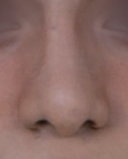 After: Broad tip and wide nostrils