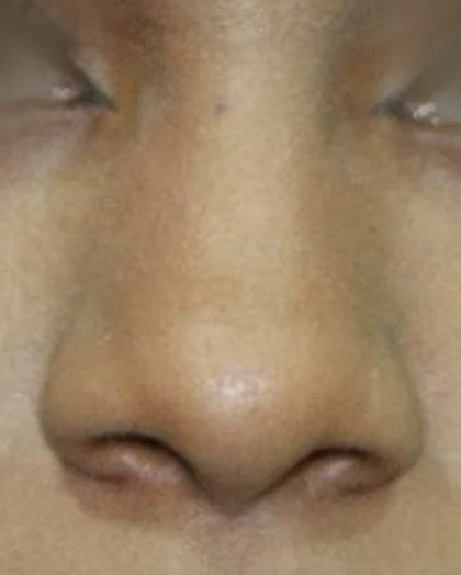 Before: Broad tip and wide nostrils