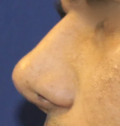 After: Revision: broad, thick nose