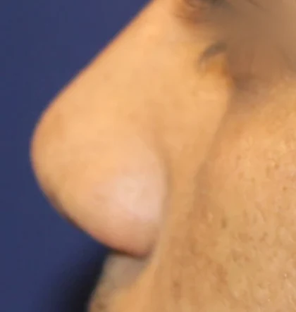 Before: Revision: broad, thick nose