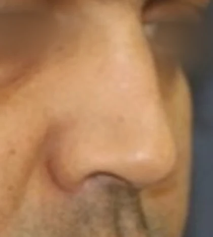 After: Revision rhinoplasty: heavy tip