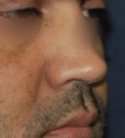 Before: Revision rhinoplasty: heavy tip