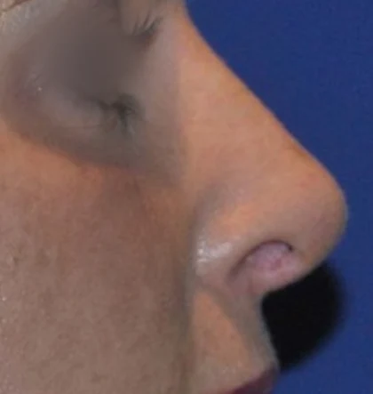 After: Revision rhinoplasty: bump and drooping tip