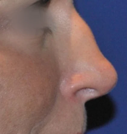 Before: Revision rhinoplasty: bump and drooping tip