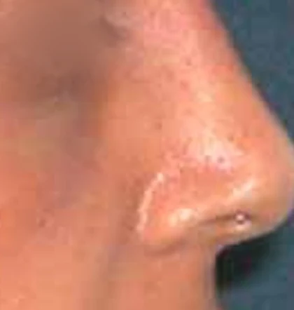 After: Revision rhinoplasty: large nose with a hump
