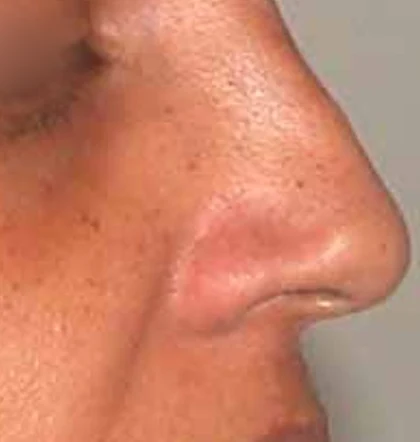 Before: Revision rhinoplasty: large nose with a hump