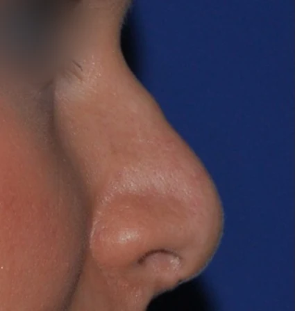 Before: Revision rhinoplasty: hump and drooping tip