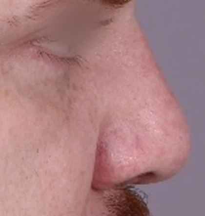 After: Revision: short, broad nose