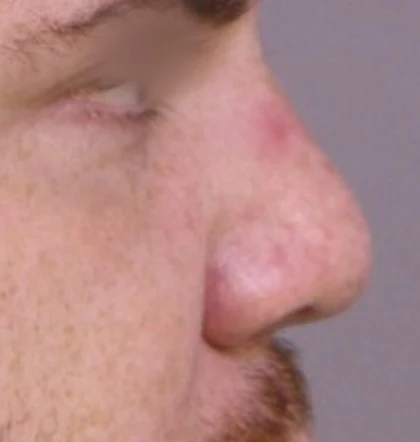 Before: Revision: short, broad nose