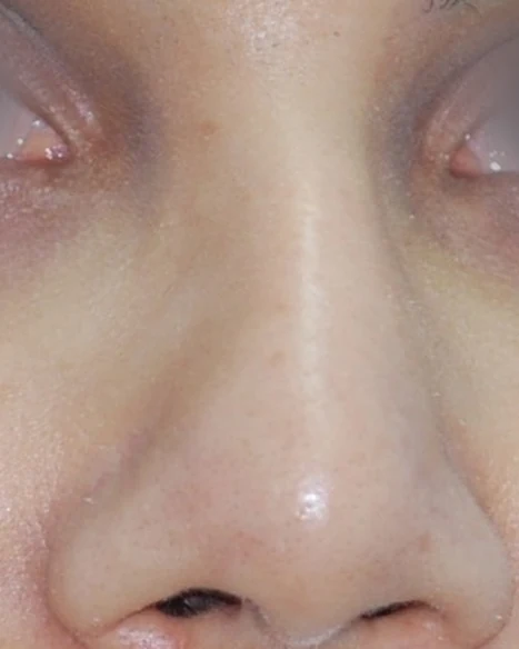 After: Revision rhinoplasty: wide tip