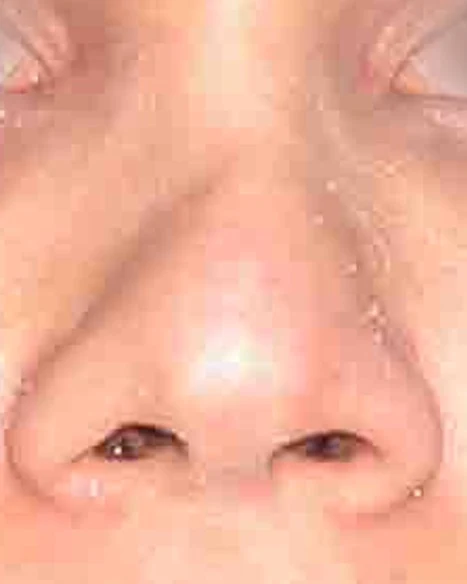 Before: Revision rhinoplasty: wide tip
