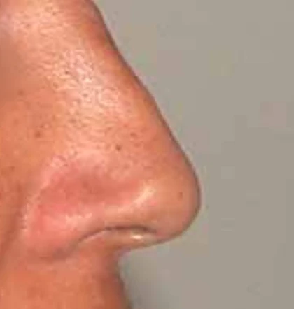 Before: Revision: softer, more feminine nose