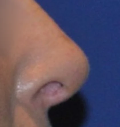 After: Revision: scooped nose