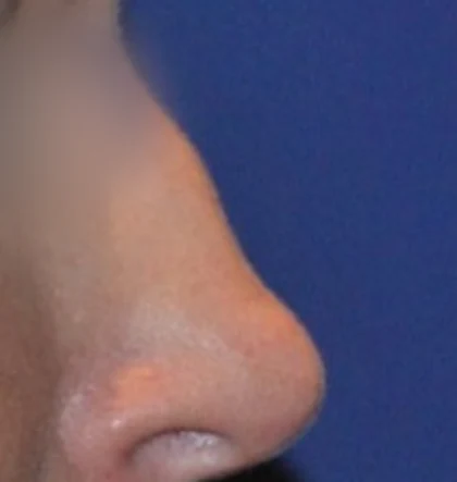 Before: Revision: scooped nose