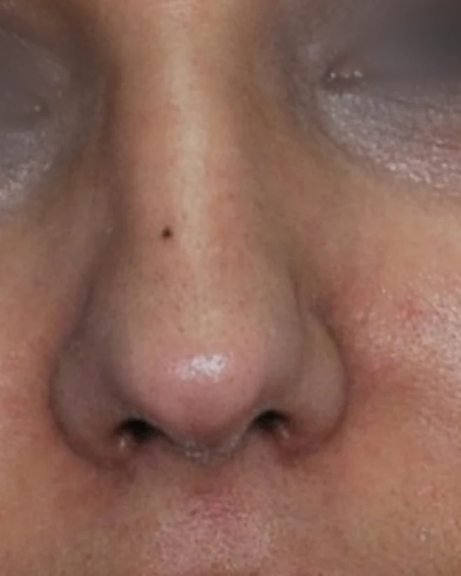 After: Tip plasty: rounded tip