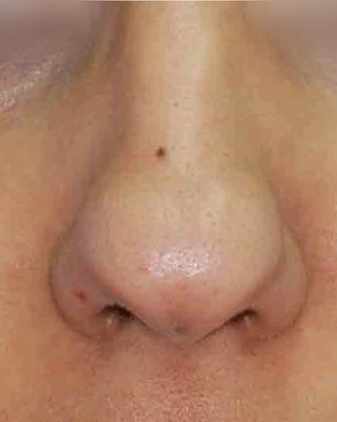 Before: Tip plasty: rounded tip
