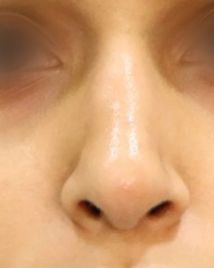 After: Tip plasty: broad tip
