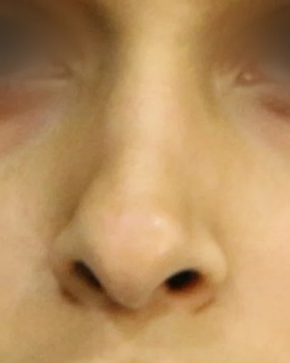 Before: Tip plasty: broad tip