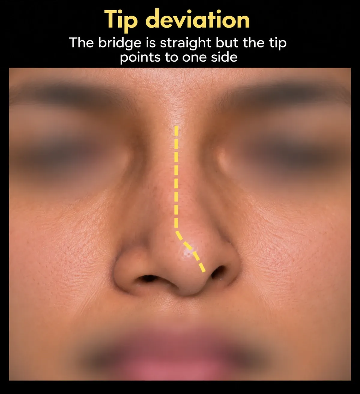 Face with a dashed line: straight bridge but the tip points to one side