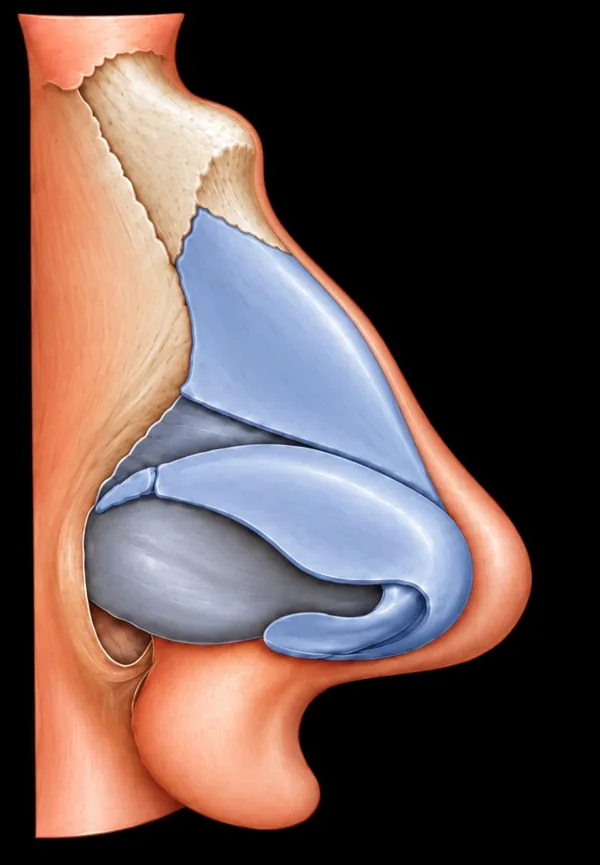 Side view illustration: hump in the nasal bones