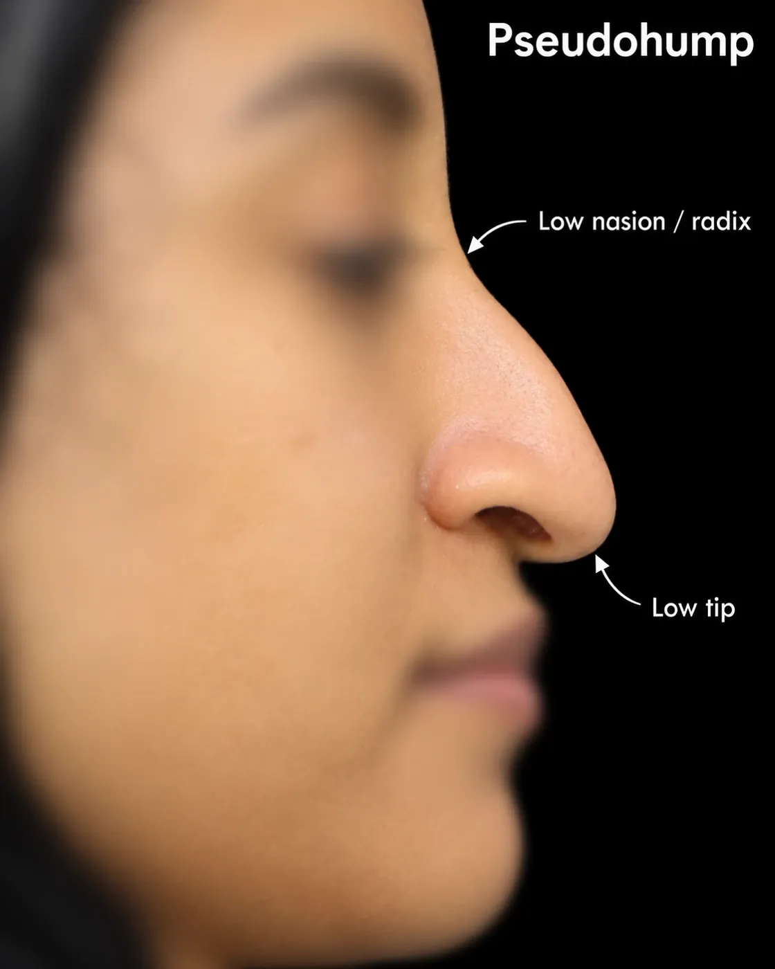 Profile photo showing a pseudohump with a low radix and a low tip