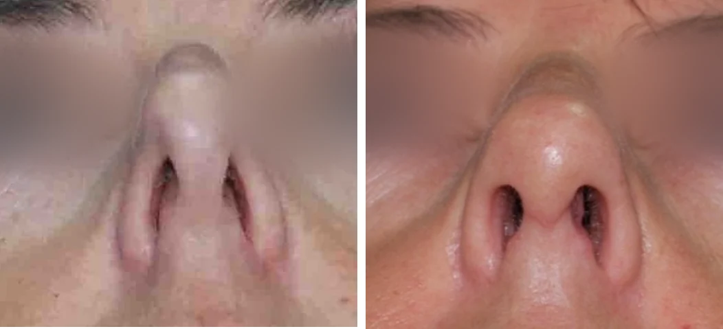 A patient's nose seen from below: on the left the nostril walls collapse inward, on the right the nostrils are open